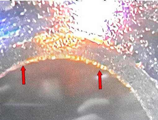 Фото 16. Повреждения в виде раковин на седле клапана форсунки (показано красными стрелками) – вид через микроскоп (увеличение 20х)