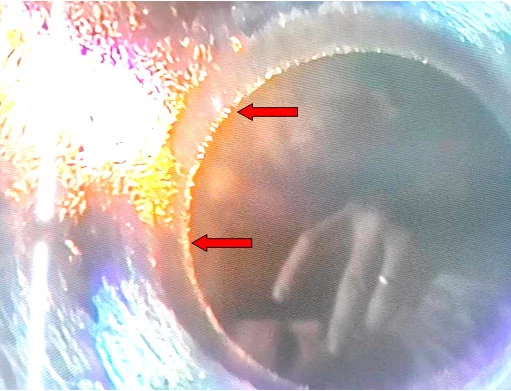 Фото 17. Повреждения в виде раковин на седле клапана форсунки (показано красными стрелками) – вид через микроскоп (увеличение 20х)